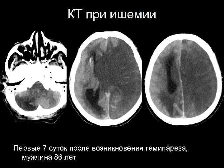 КТ при ишемии Первые 7 суток после возникновения гемипареза, мужчина 86 лет 