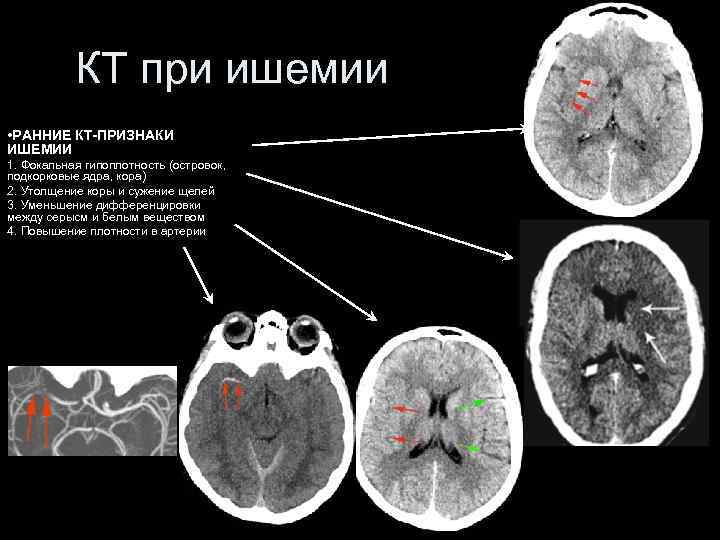 Инсульт современные технологии диагностики и лечения руководство для врачей