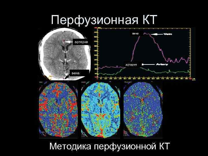 Перфузионная КТ вена артерия вена Методика перфузионной КТ 