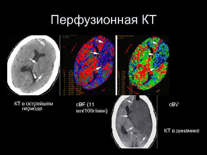 Перфузионная КТ КТ в острейшем периоде c. BF (11 мл/100 г/мин) c. BV КТ