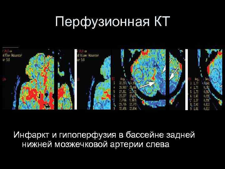 Перфузионная КТ Инфаркт и гипоперфузия в бассейне задней нижней мозжечковой артерии слева 