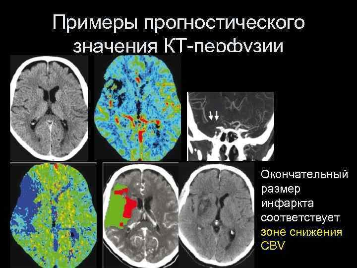 Кт с контрастом в брянске. Ламинарный корковый инсульт на кт. Кт значение.