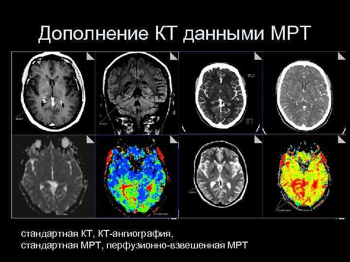 Мрт инсульт картинки