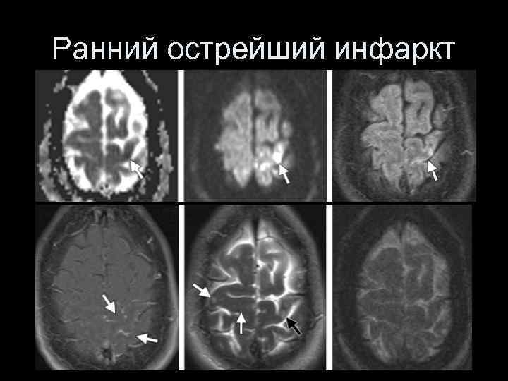 Острый ишемический инсульт клиническая картина