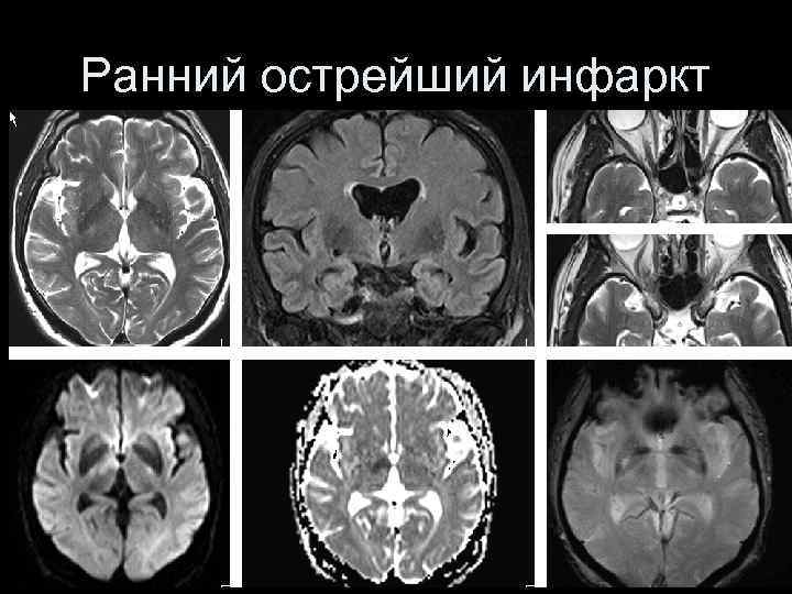 Ранний острейший инфаркт 