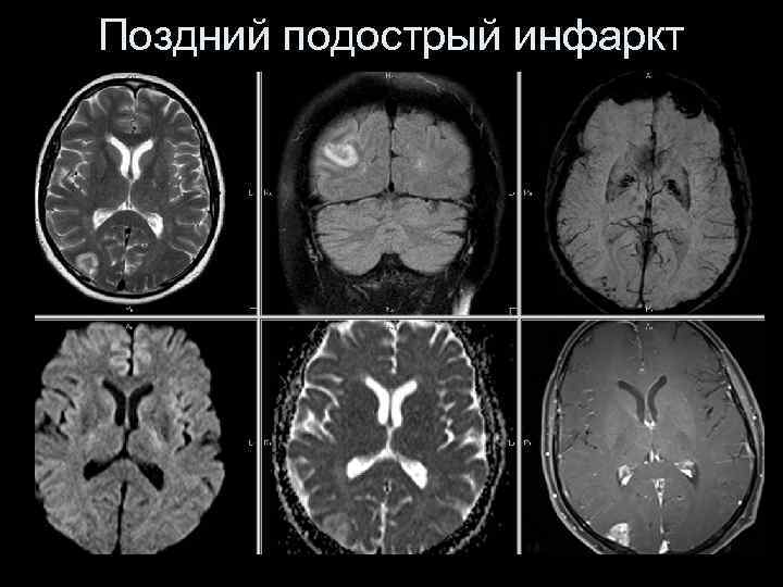 Поздний подострый инфаркт 