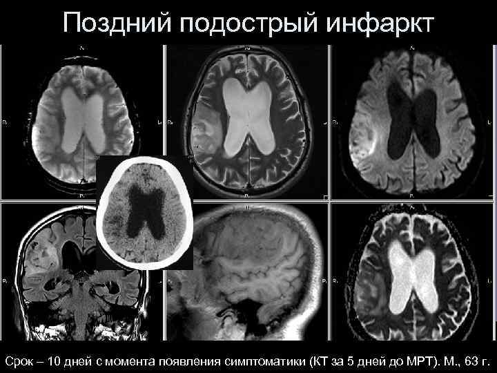 Инсульт современные технологии диагностики и лечения руководство для врачей