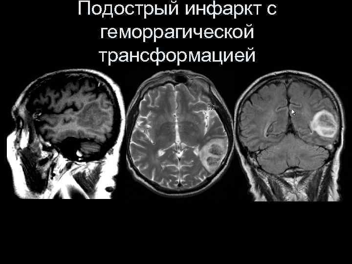 Геморрагический инсульт клиническая картина