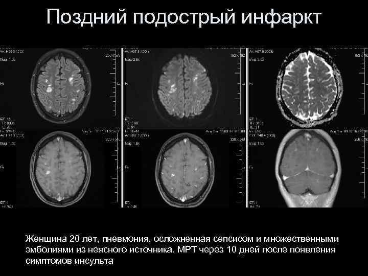 Поздний подострый инфаркт Женщина 20 лет, пневмония, осложненная сепсисом и множественными эмболиями из неясного