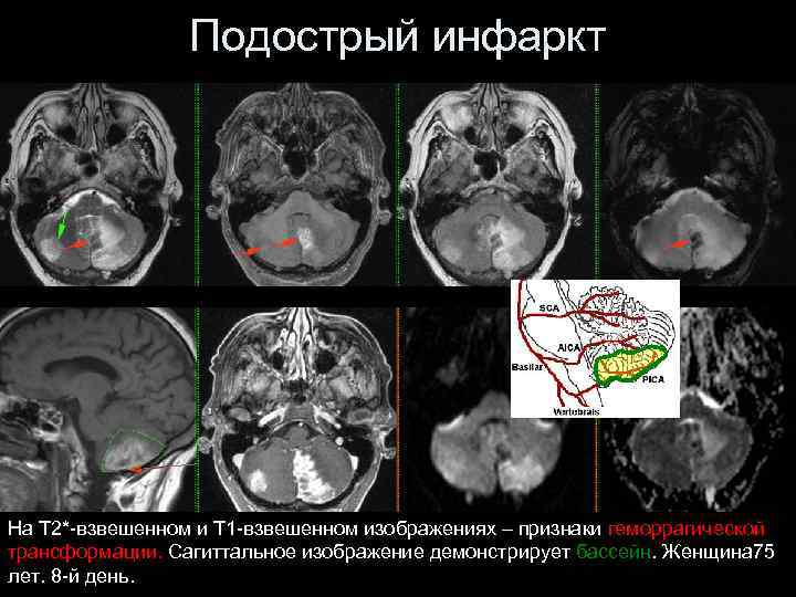 Подострый инфаркт На Т 2*-взвешенном и Т 1 -взвешенном изображениях – признаки геморрагической трансформации.