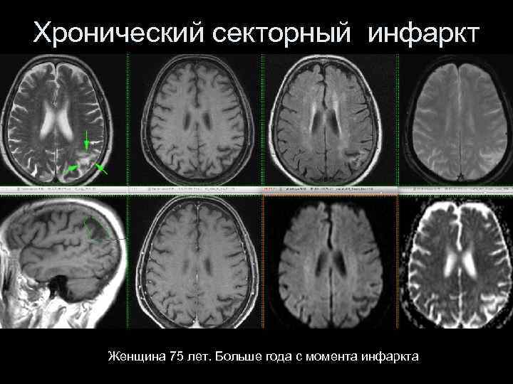 Хронический секторный инфаркт Женщина 75 лет. Больше года с момента инфаркта 