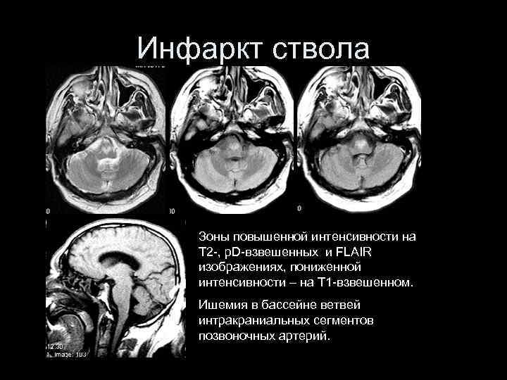 Инфаркт ствола Зоны повышенной интенсивности на T 2 -, p. D-взвешенных и FLAIR изображениях,