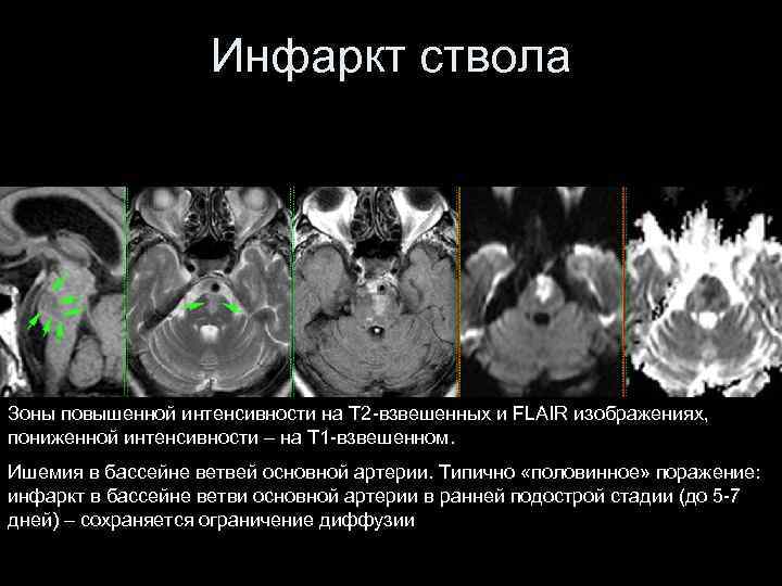 Инфаркт ствола Зоны повышенной интенсивности на T 2 -взвешенных и FLAIR изображениях, пониженной интенсивности