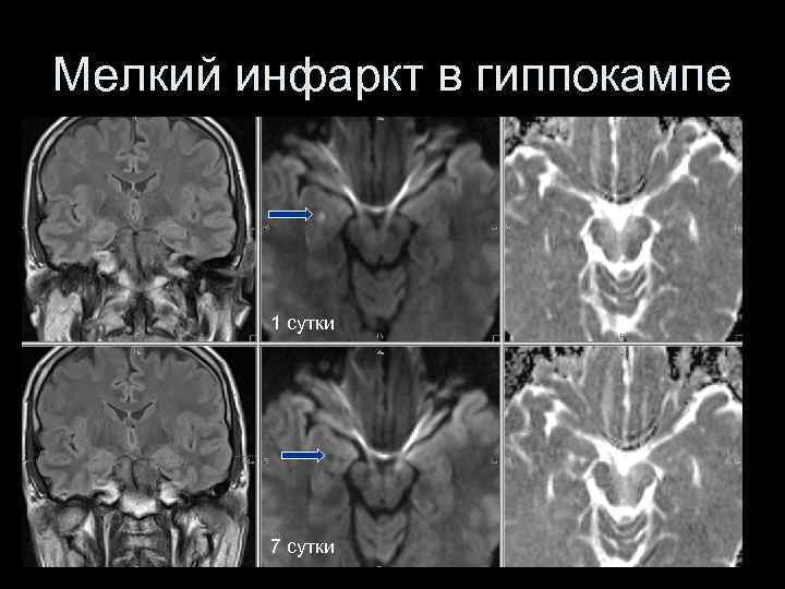 Мелкий инфаркт в гиппокампе 1 сутки 7 сутки 