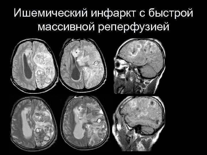 Ишемический инфаркт с быстрой массивной реперфузией 