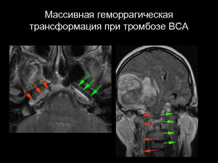 Геморрагическая трансформация. Геморрагическая трансформация инфаркта головного мозга. Геморрагическая трансформация инсульта типы.