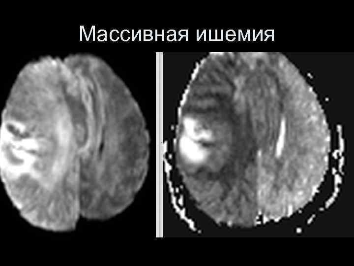 Массивная ишемия 