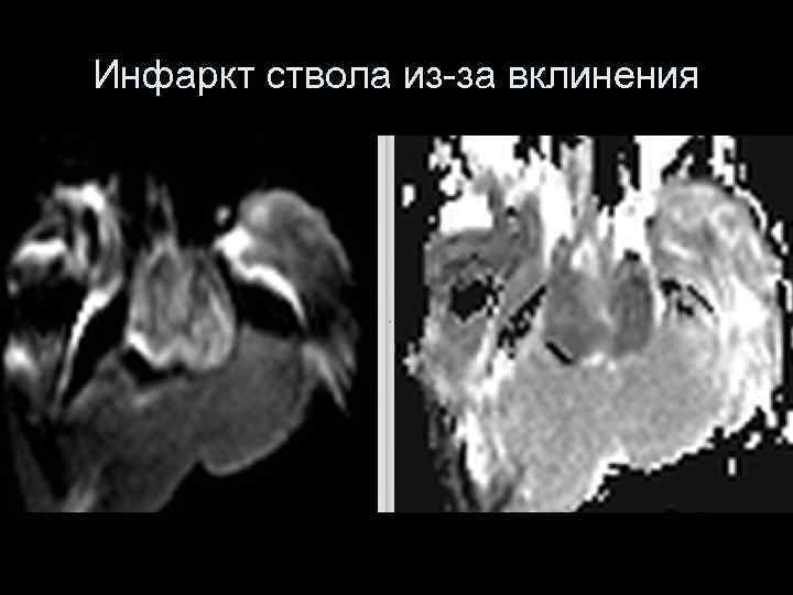 Инфаркт ствола из-за вклинения 