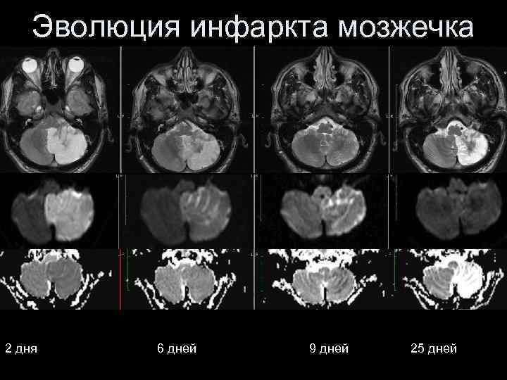 Эволюция инфаркта мозжечка 2 дня 6 дней 9 дней 25 дней 