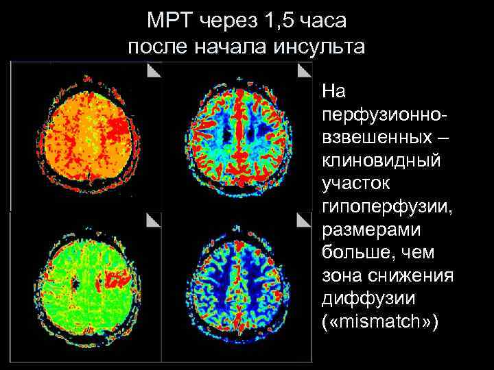 МРТ через 1, 5 часа после начала инсульта На перфузионновзвешенных – клиновидный участок гипоперфузии,