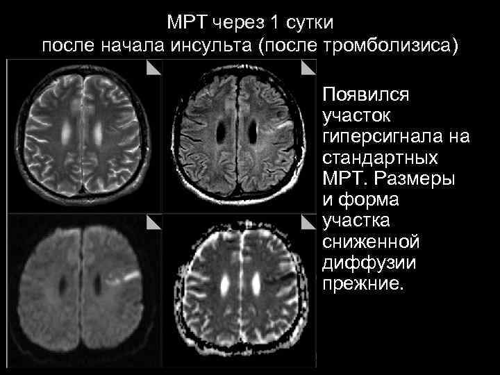 МРТ через 1 сутки после начала инсульта (после тромболизиса) Появился участок гиперсигнала на стандартных