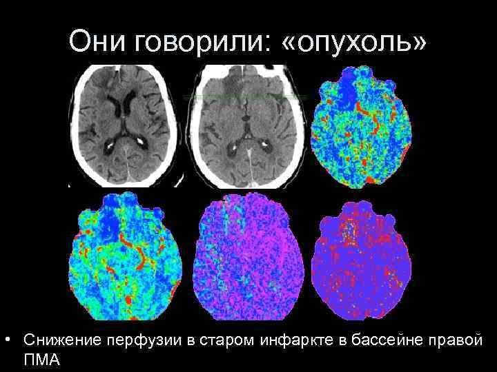 Они говорили: «опухоль» • Снижение перфузии в старом инфаркте в бассейне правой ПМА 