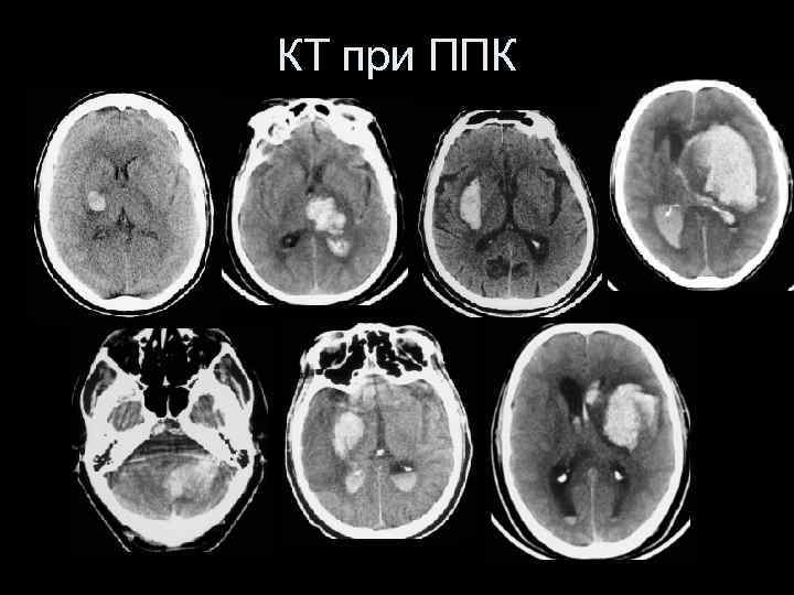 КТ при ППК 