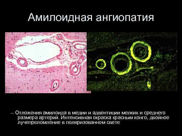 Амилоидная ангиопатия – Отложения амилоида в медии и адвентиции мелких и среднего размера артерий.