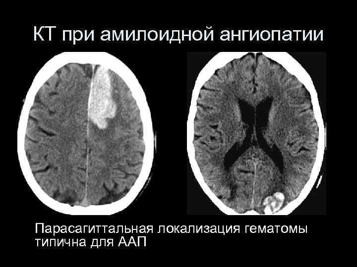 КТ при амилоидной ангиопатии Парасагиттальная локализация гематомы типична для ААП 