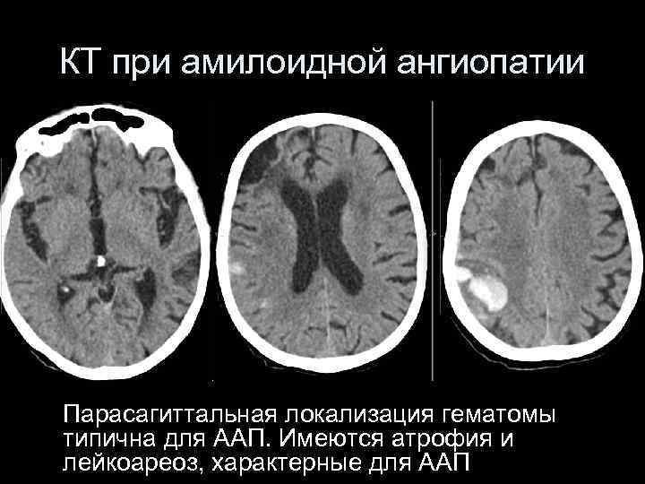 Лейкоареоз головного мозга