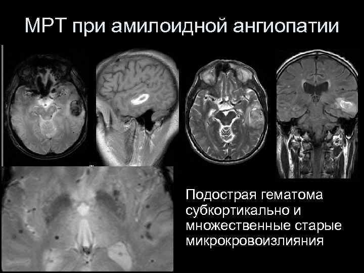 МРТ при амилоидной ангиопатии Подострая гематома субкортикально и множественные старые микрокровоизлияния 