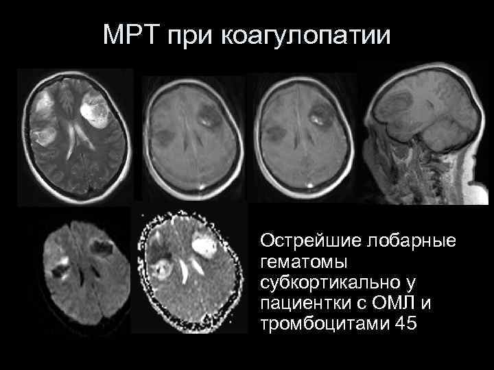 Гематомы при гемофилии фото