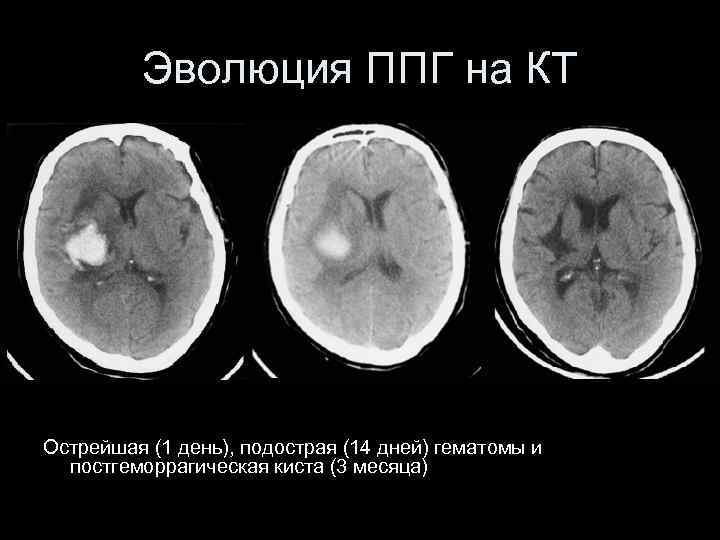 Эволюция ППГ на КТ Острейшая (1 день), подострая (14 дней) гематомы и постгеморрагическая киста