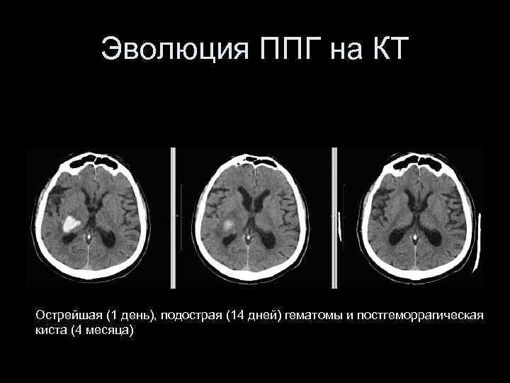 Эволюция ППГ на КТ Острейшая (1 день), подострая (14 дней) гематомы и постгеморрагическая киста