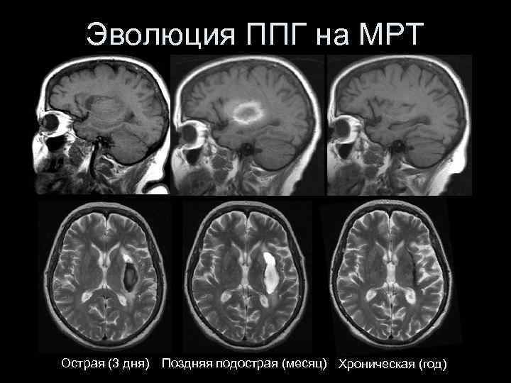 Эволюция ППГ на МРТ а Острая (3 дня) Поздняя подострая (месяц) Хроническая (год) 