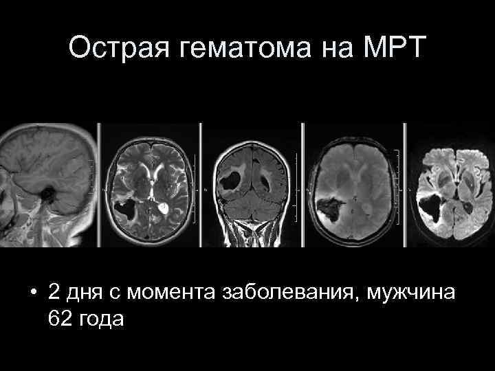 Острая гематома на МРТ • 2 дня с момента заболевания, мужчина 62 года 