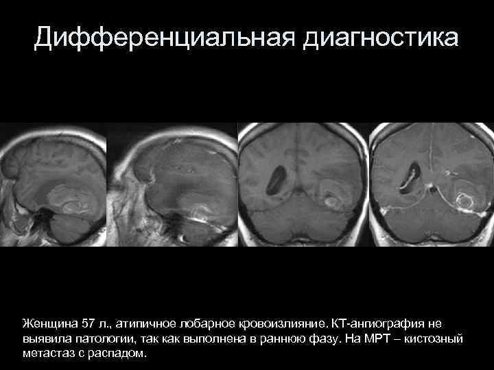 Дифференциальная диагностика Женщина 57 л. , атипичное лобарное кровоизлияние. КТ-ангиография не выявила патологии, так