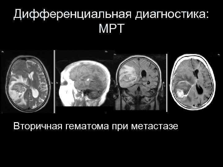 Дифференциальная диагностика: МРТ Вторичная гематома при метастазе 