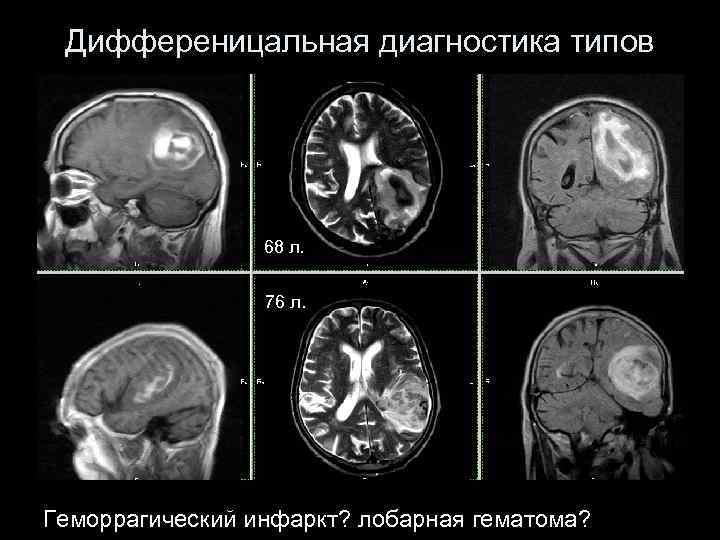 Дифференицальная диагностика типов 68 л. 76 л. Геморрагический инфаркт? лобарная гематома? 