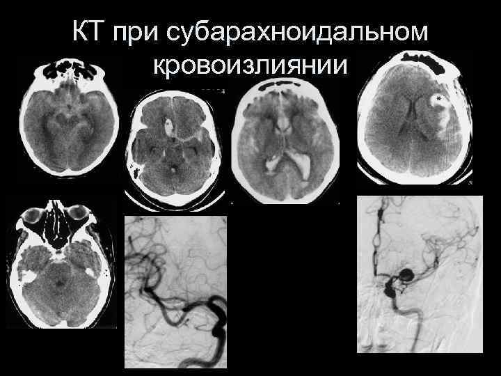 КТ при субарахноидальном кровоизлиянии 