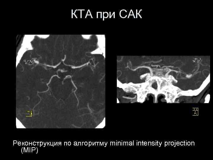 КТА при САК Реконструкция по алгоритму minimal intensity projection (MIP) 