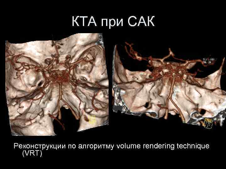 КТА при САК Реконструкции по алгоритму volume rendering technique (VRT) 