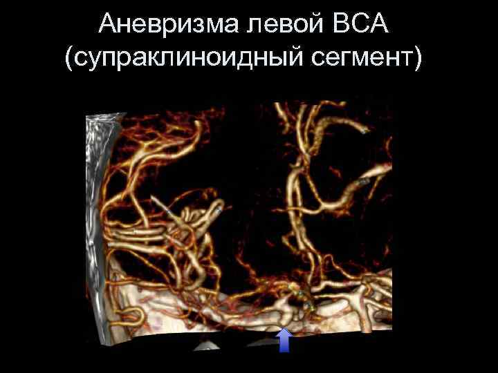 Аневризма левой ВСА (супраклиноидный сегмент) 