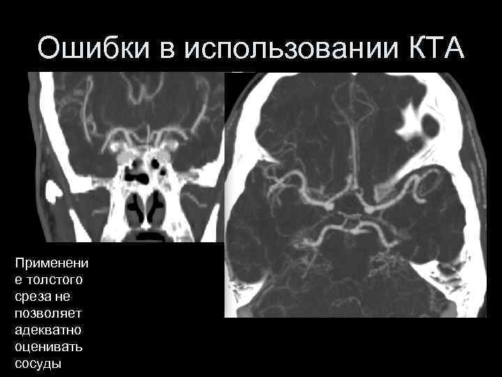 Ошибки в использовании КТА Применени е толстого среза не позволяет адекватно оценивать сосуды 