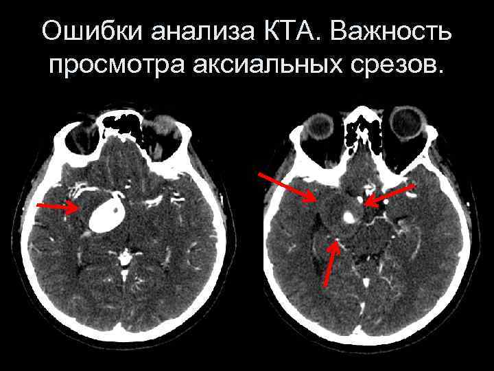 Ошибки анализа КТА. Важность просмотра аксиальных срезов. 