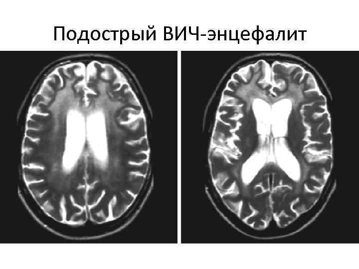 Подострый ВИЧ-энцефалит 