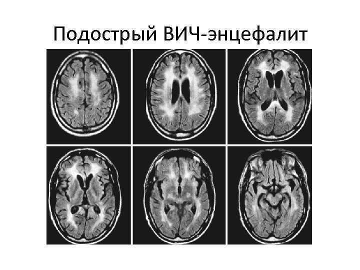 Подострый ВИЧ-энцефалит 