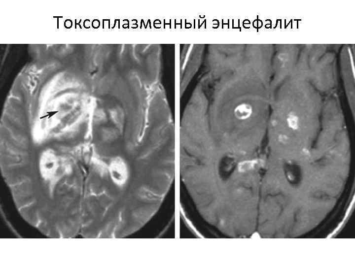 Энцефалит мрт картина