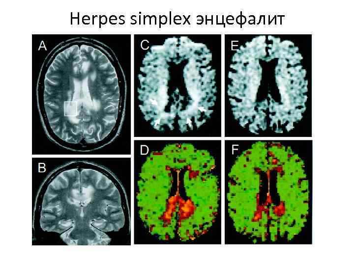 Herpes simplex энцефалит 