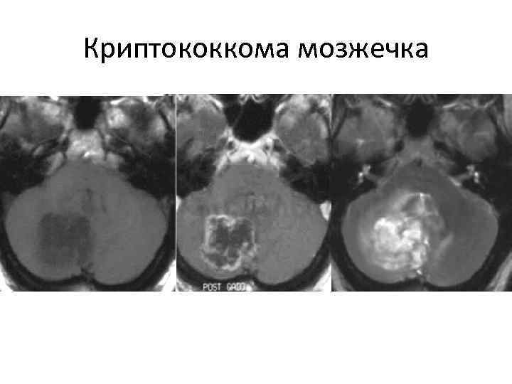 Криптококкома мозжечка 